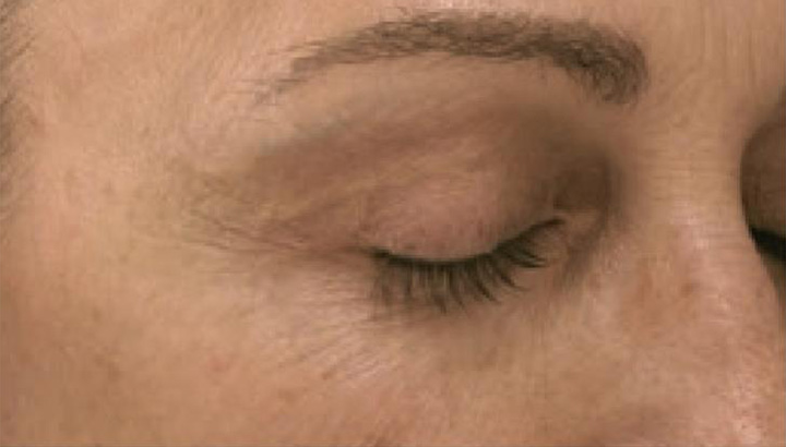 Crows-Feet-Before-Exceed-Lash Aesthetics