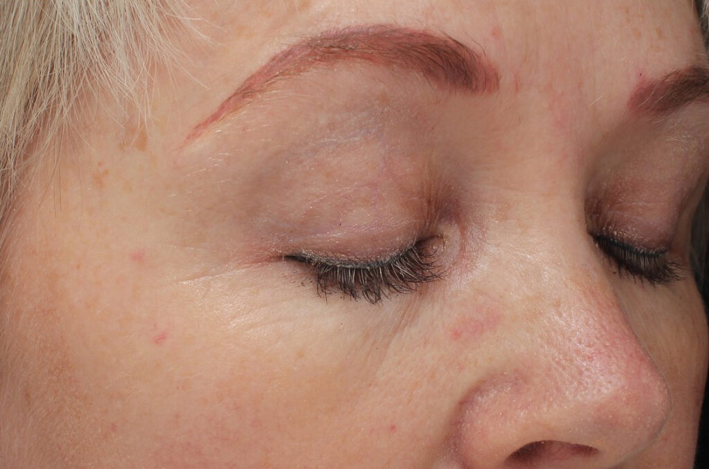 Beautifeye-After-Pic