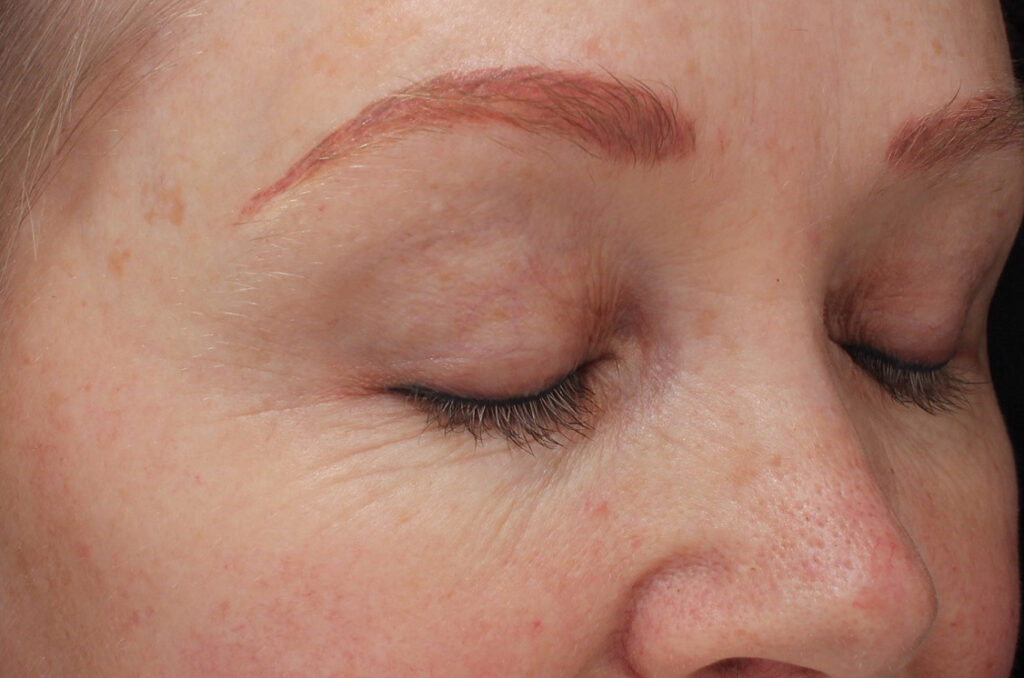 Beautifeye-Before-Pic